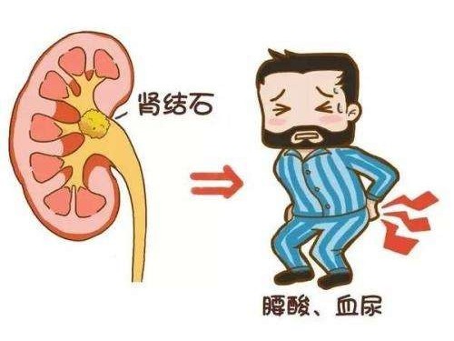 得了腎結(jié)石怎么辦？